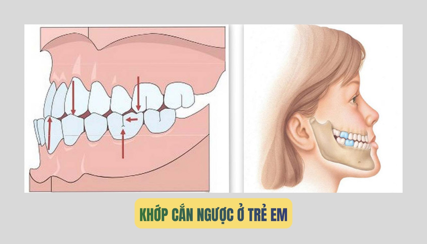 Khớp cắn ngược ở trẻ em