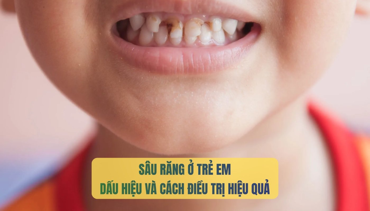 Cách chữa sâu răng ở trẻ em hiệu quả