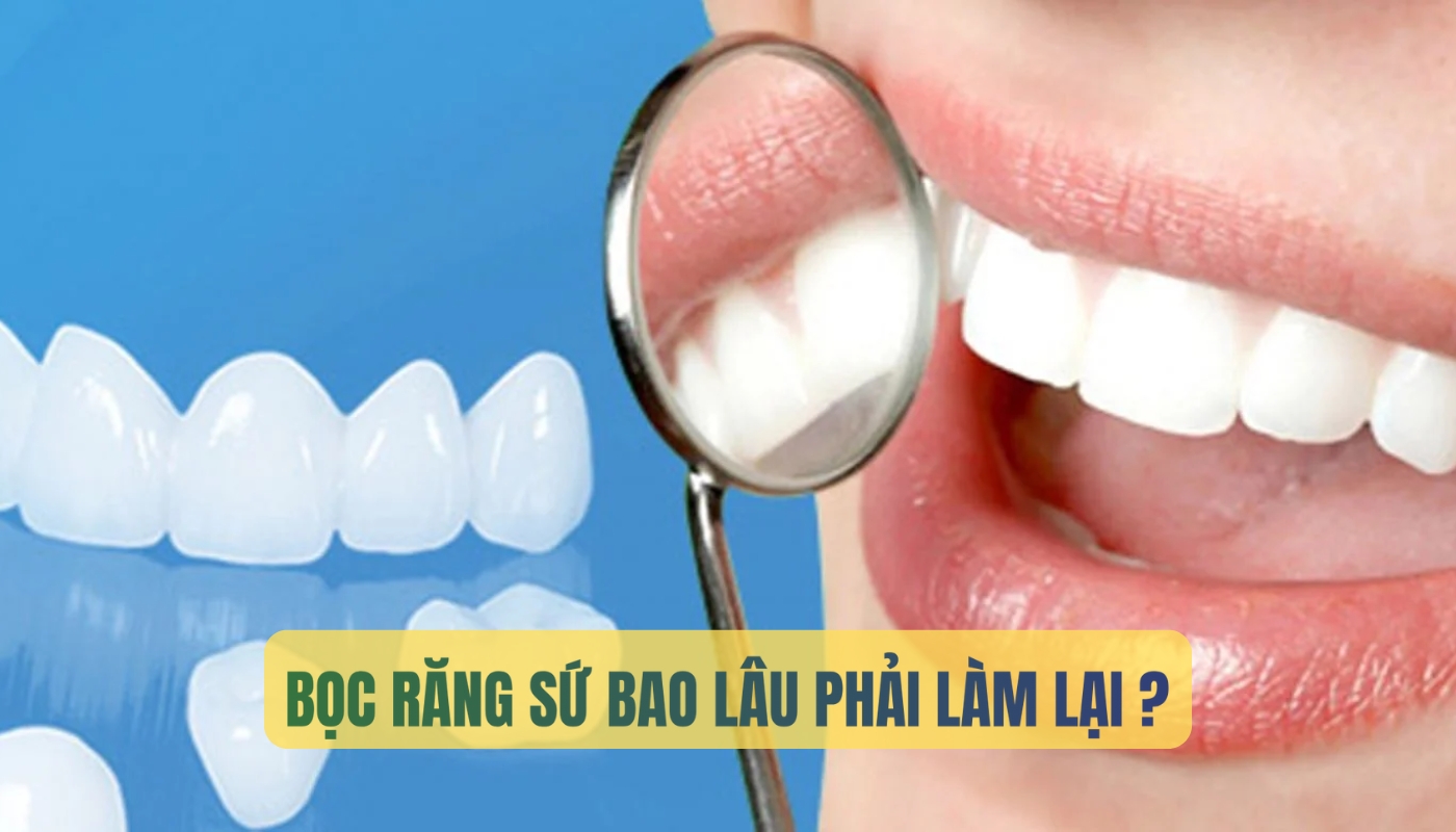 Bọc răng sứ bao lâu phải làm lại?