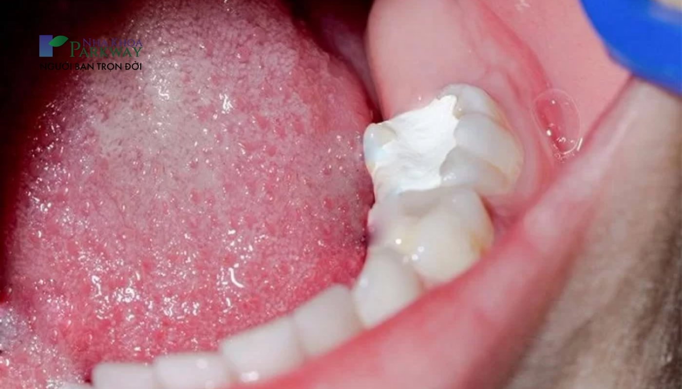 Răng đã được trám nhưng ảnh hưởng đến chức năng ăn nhai