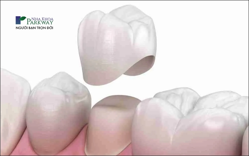 Bọc răng sứ là một quá trình phục hình thẩm mỹ sử dụng các mão răng sứ để chụp lên những cùi răng đã được mài sẵn