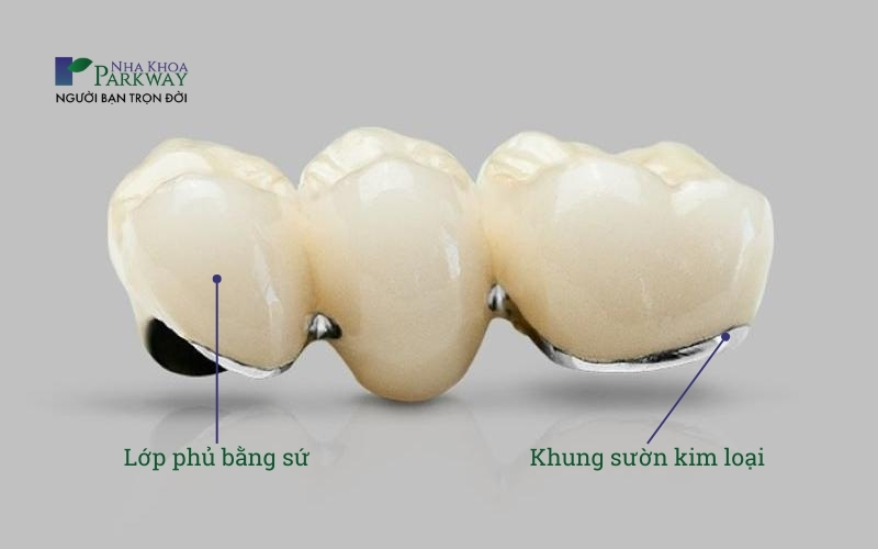 Răng sứ kim loại có phần sườn làm từ hợp kim và bên ngoài phủ một lớp sứ mỏng