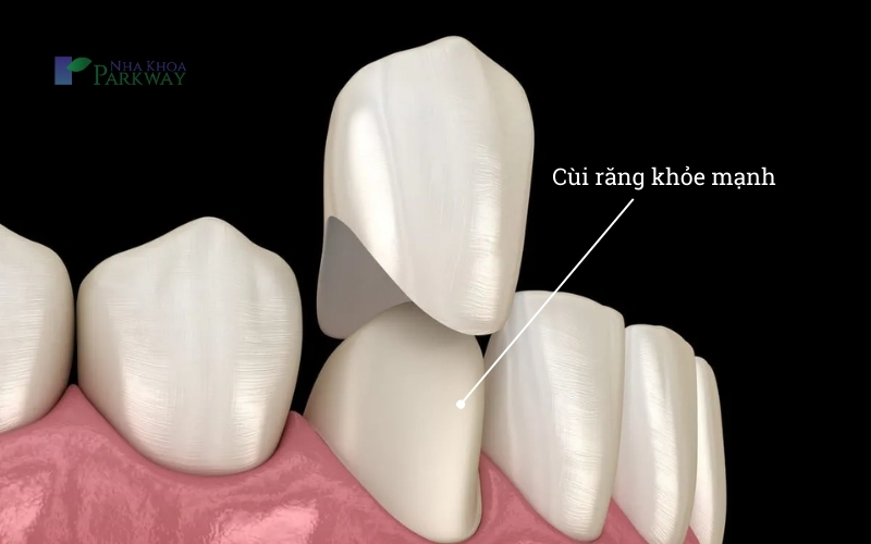 Tình trạng cùi răng ảnh hưởng đến độ bền của việc bọc răng sứ