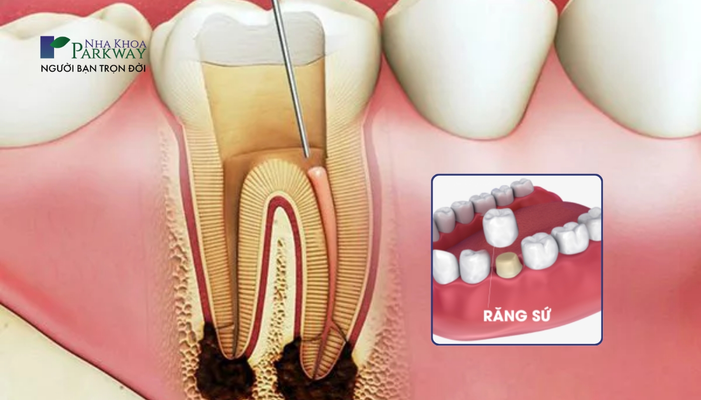 Hình ảnh răng chữa tủy và bọc răng sứ