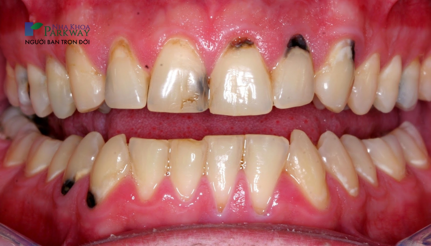trên răng xuất hiện trên răng và nướu