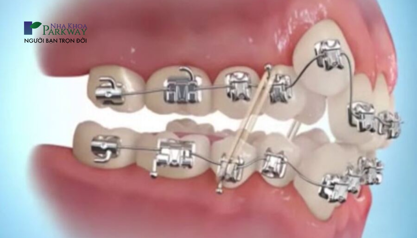 Hình ảnh răng đã được gắn mắc cài