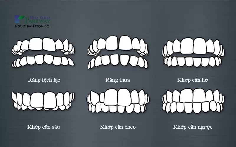 Các trường hợp cần thực hiện niềng răng