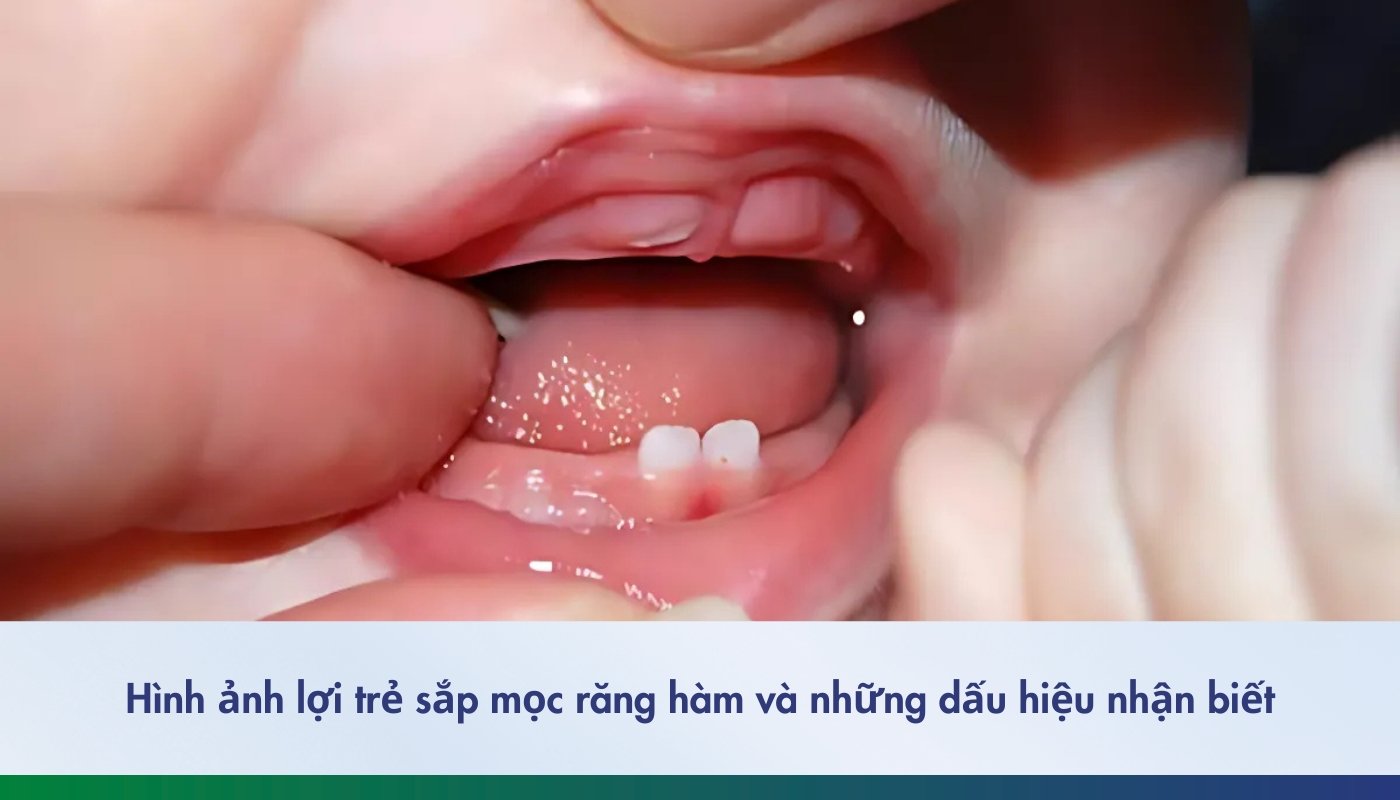 hình ảnh lợi trẻ sắp mọc răng hàm