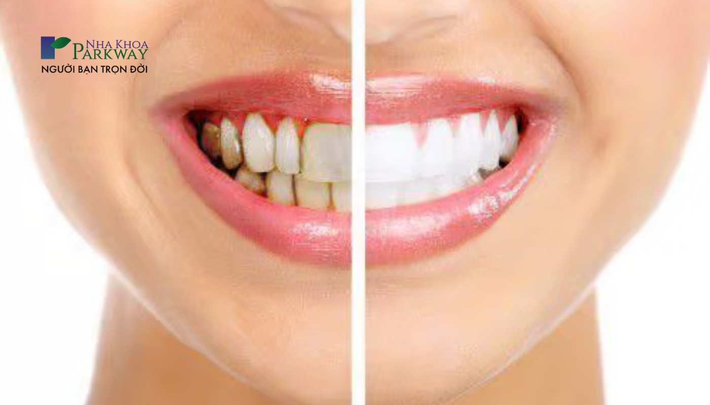 Hình ảnh răng bị nhiễm màu trước và sau khi bọc răng sứ