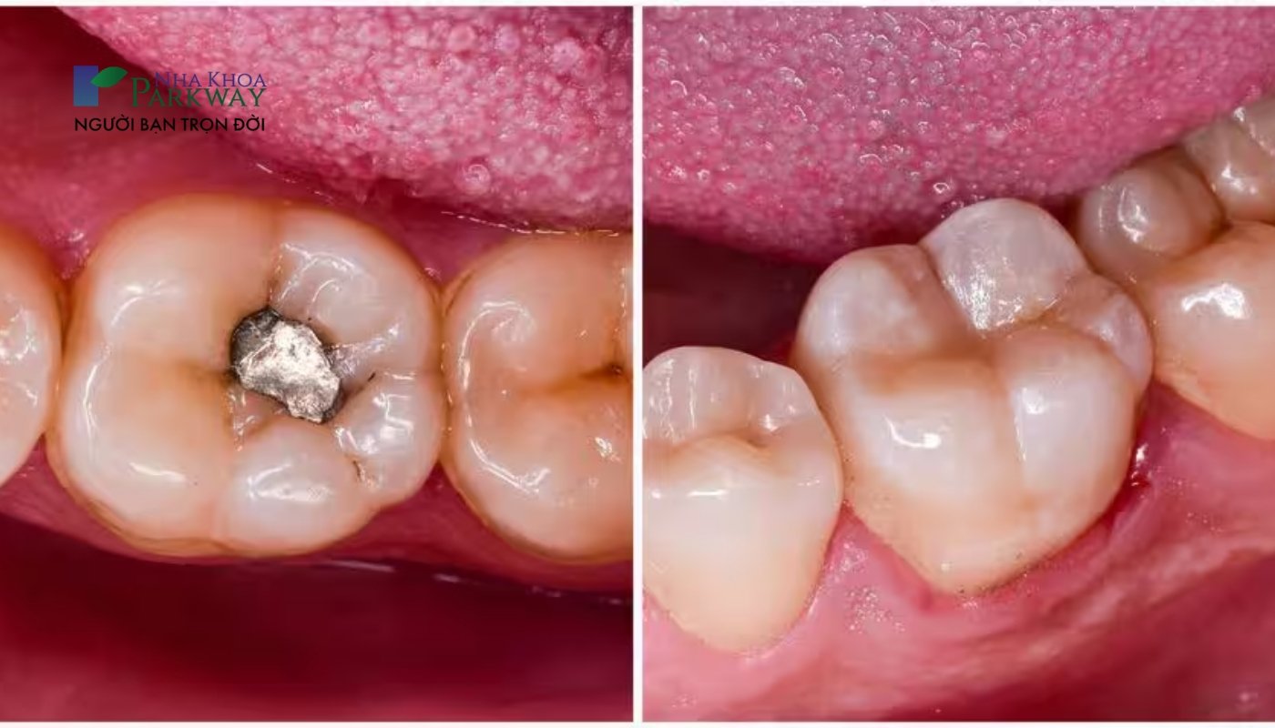 Hình ảnh răng trước và sau khi trám