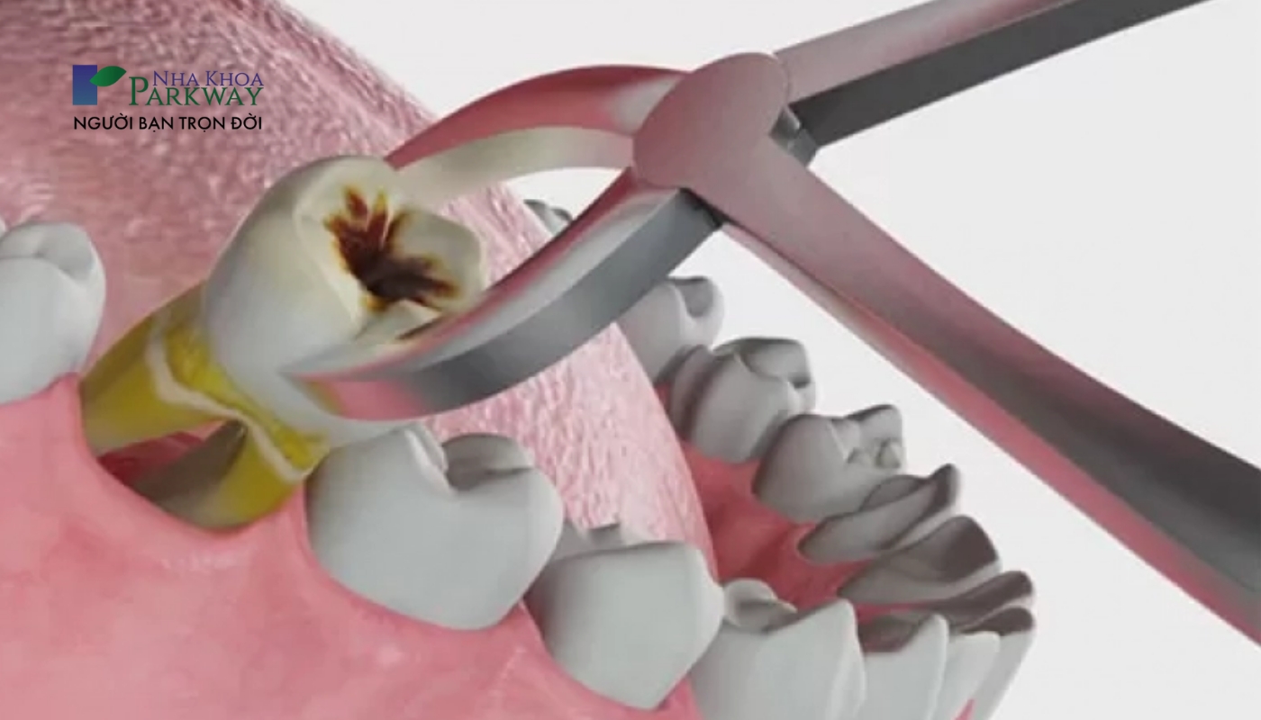 Hình ảnh kềm nha khoa đang nhổ chiếc răng ra khỏi hàm