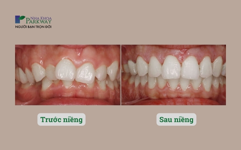 Ảnh minh họa trước và sau khi niềng răng điều trị sai lệch khớp cắn