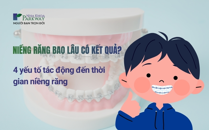 4 yếu tố tác động đến thời gian niềng răng