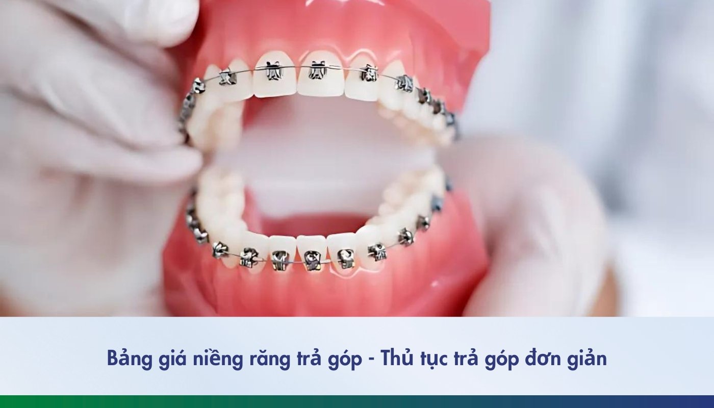 niềng răng trả góp và thủ tục