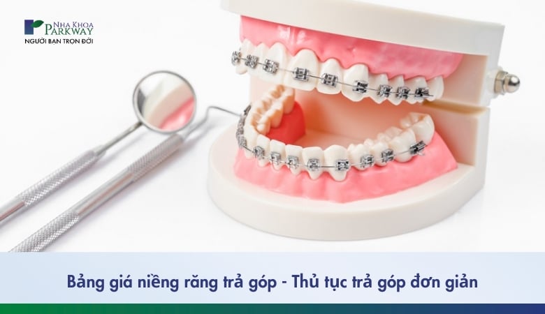 niềng răng trả góp