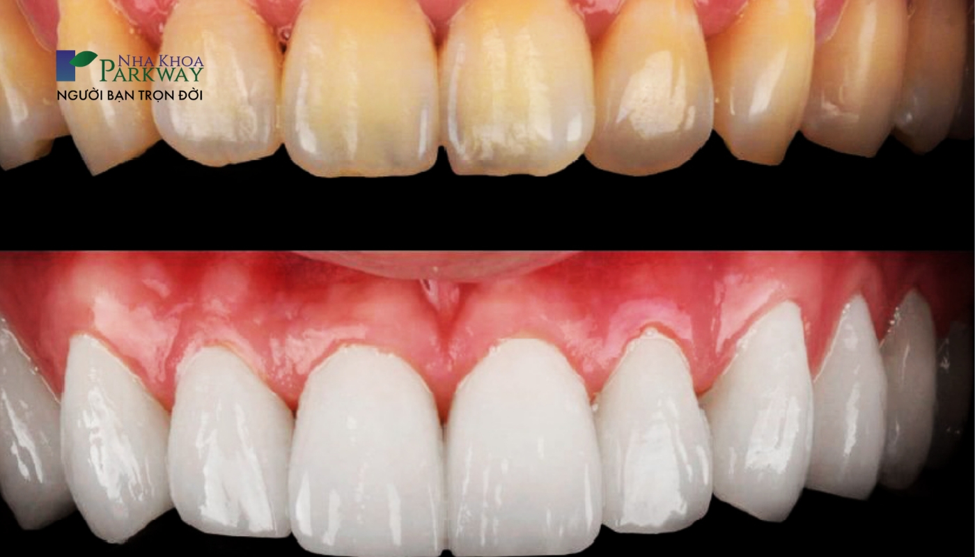 Hình ảnh răng bị ố vàng trước và sau khi bọc răng sứ