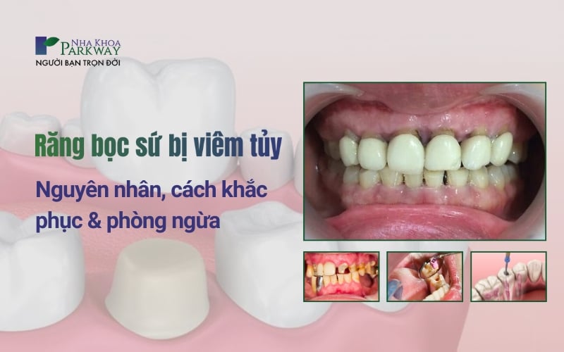 Nguyên nhân và cách phòng ngừa răng bọc sứ bị viêm tủy