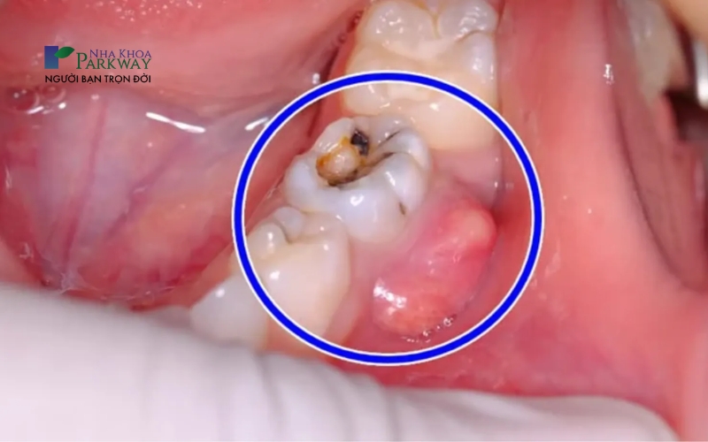 Sâu răng kéo dài là nguyên nhân khiến răng bọc sứ bị viêm tủy