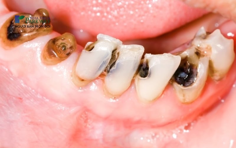 Răng bọc sứ bị viêm tủy do chưa điều trị khỏi hẳn hoàn toàn 