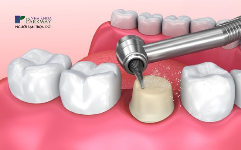 Mài mô răng quá nhiều có thể khiến răng bọc sứ bị viêm tủy