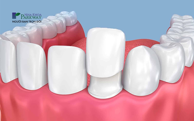 Không làm răng tạm trước khi chụp sứ có thể khiến cho cùi răng bị viêm tủy
