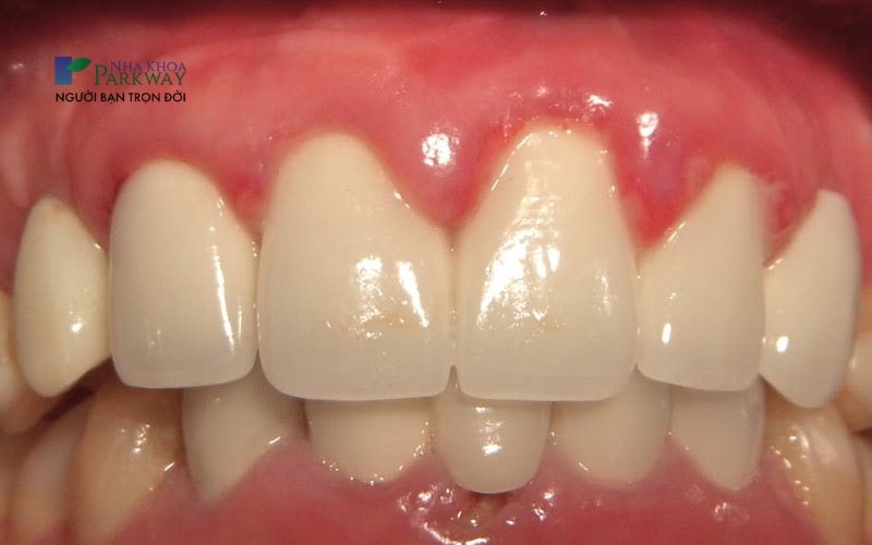 Nướu răng bị sưng tấy là biểu hiện nguy cơ răng bọc sứ bị viêm tủy