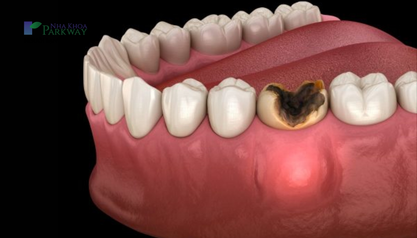 răng sâu cần điều trị tủy