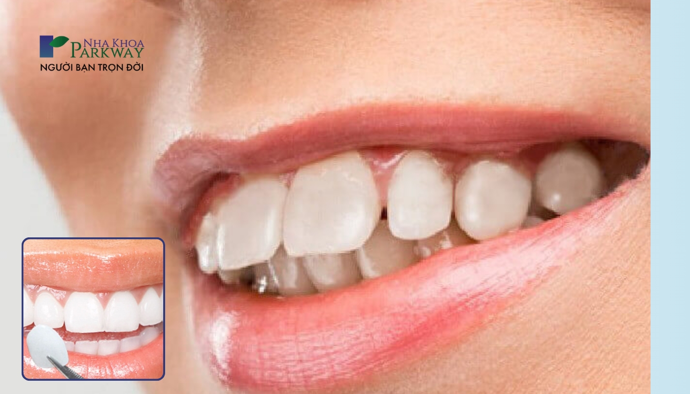 Răng hô móm nhẹ thực hiện phương pháp bọc răng sứ