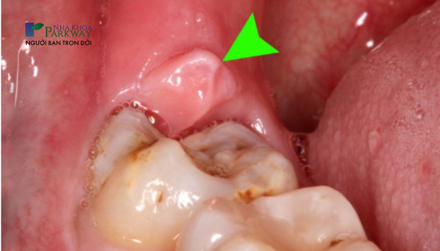 Răng khôn mọc lệch gây viêm nướu