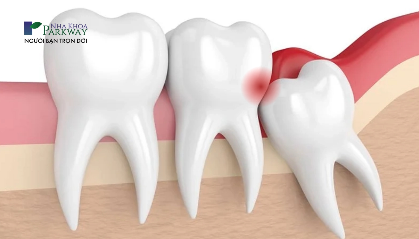 Hình ảnh răng khôn mọc lệch đâm vào răng bên cạnh