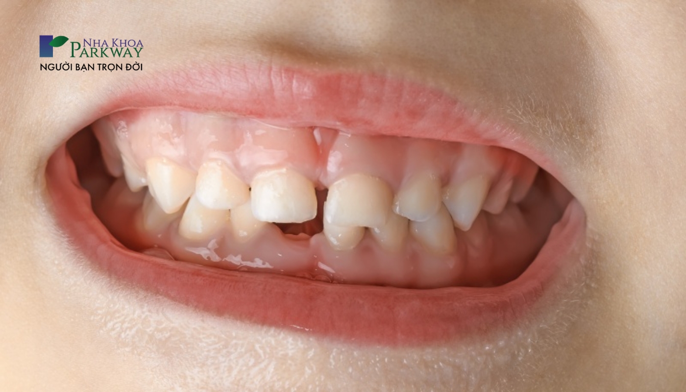 hàm răng mọc lệch có kích thước không đều