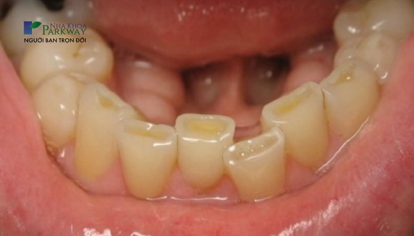 răng bị mòn mặt nhai