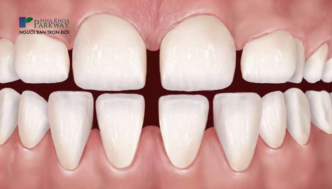 Hình ảnh hàm răng bị thưa hở kẽ