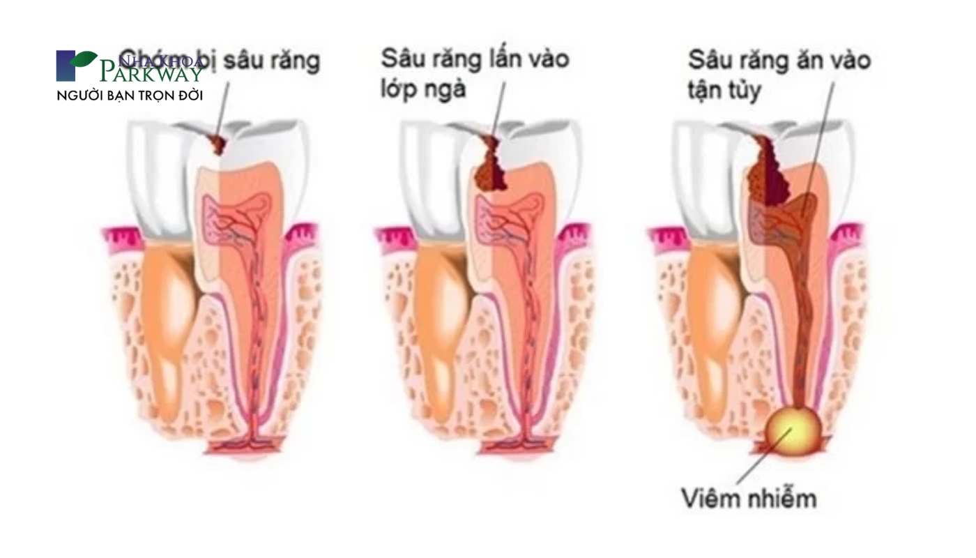 Sâu răng và viêm tủy gây đau răng