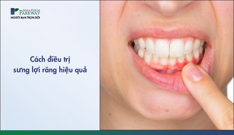 Cách điều trị sưng lợi răng cửa hiệu quả