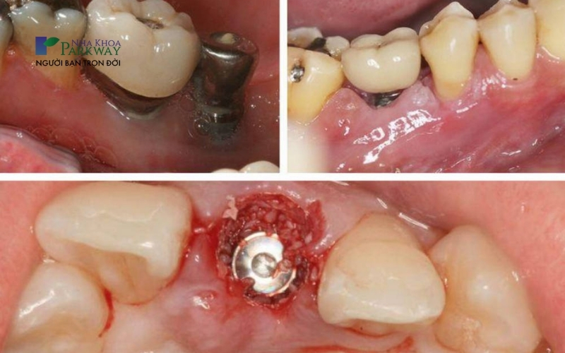 Trồng răng Implant kém chất lượng không đảm bảo được các tiêu chuẩn an toàn