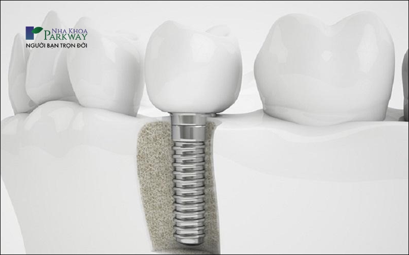 Sử dụng trụ Implant kém chất lượng có thể dẫn đến việc implant bị lỏng lẻo và có thể rơi ra