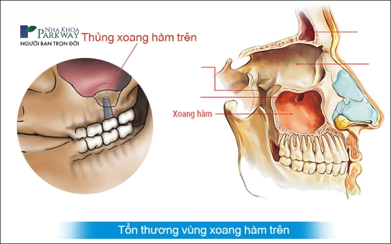 Trồng răng implant kém chất lượng có thể gây thủng xương hàm