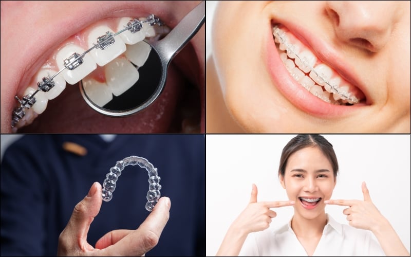 Niềng răng nhanh hay chậm còn phụ thuộc vào phương pháp niềng cụ thể