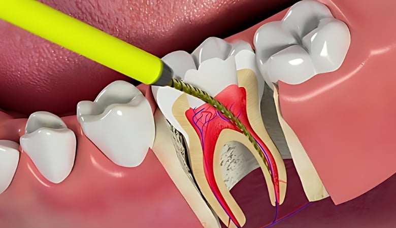 hình ảnh mô phòng lấy tủy khi trám răng sâu