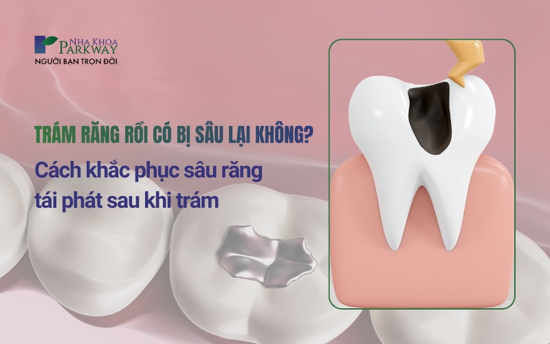 Cách khắc phục sâu răng tái phát sau khi trám