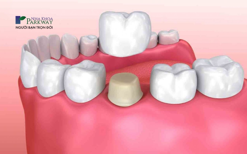 Bọc răng sứ cho răng bị sâu sau khi trám