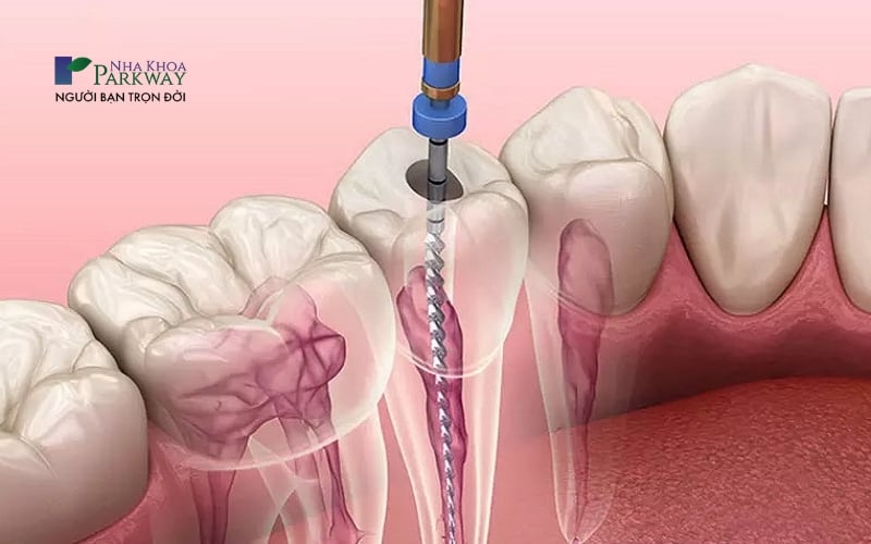 Trám răng sâu cần lấy tủy khi tủy răng đã bị tổn thương hoặc có bệnh lý