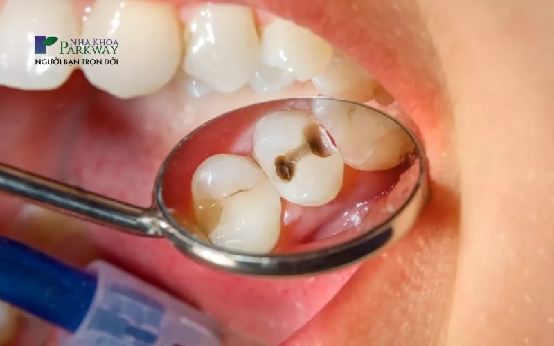 Các trường hợp cần lấy tủy trước khi trám răng sâu