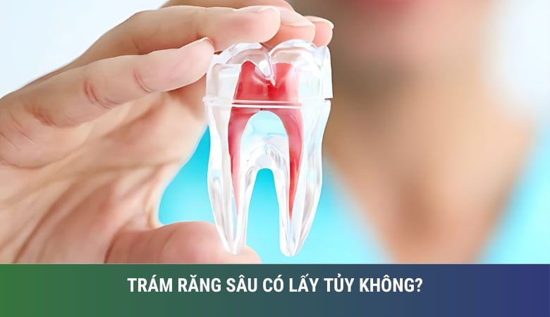 trám răng sâu có cần lấy tủy không