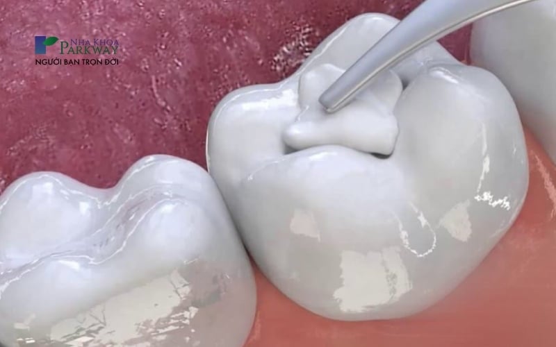 Hình ảnh mô phỏng quá trình trám răng sâu thông thường