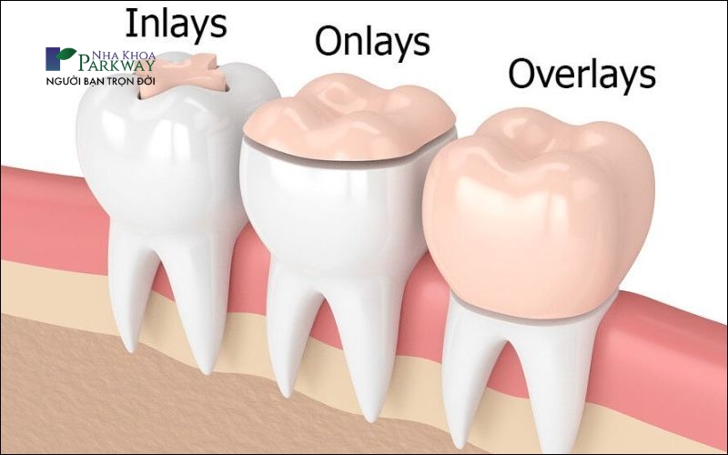 Ảnh mô tả sự khác nhau giữa 3 phương pháp trám răng Inlay, Onlay và Overlays