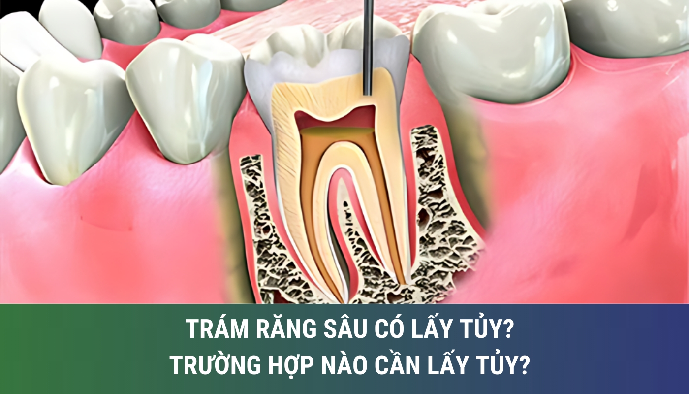 trám răng sâu có lẩy tủy không? trường hợp nào cần lấy tủy