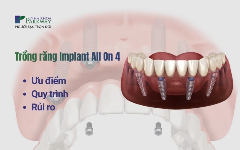 Tìm hiểu những ưu điểm của kỹ thuật trồng răng Implant All On 4