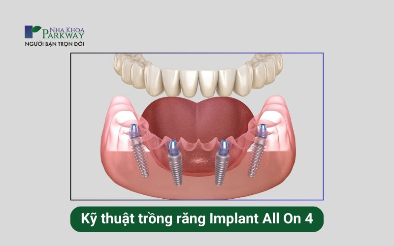 Trồng răng Implant All On 4 chỉ cần sử dụng tối đa 4 trụ implant trên một hàm